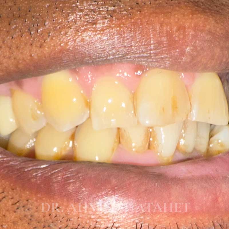 After dental treatment case 1