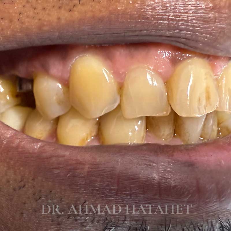Before dental treatment case 1