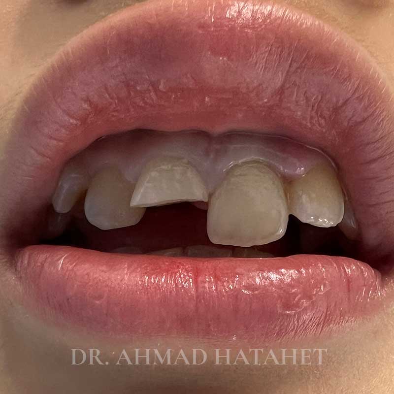 Before dental treatment case 2