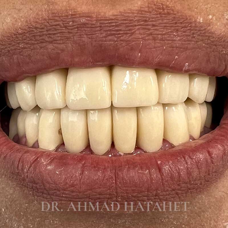 After dental treatment case 3