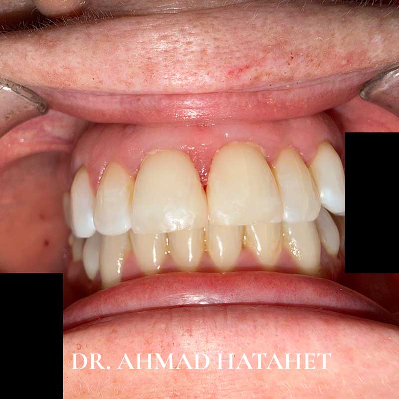 After dental treatment case 4
