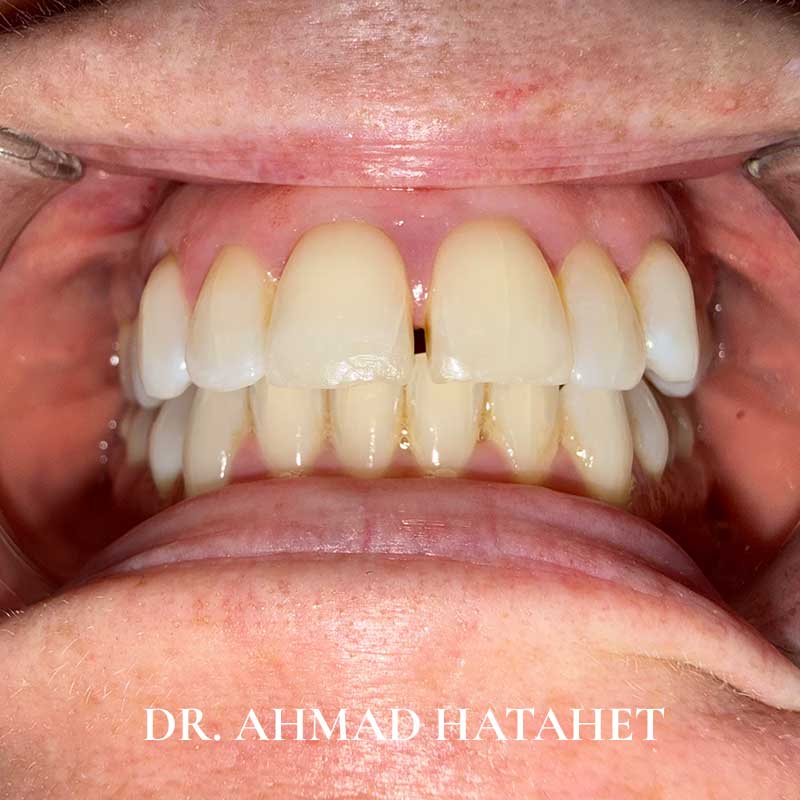Before dental treatment case 4