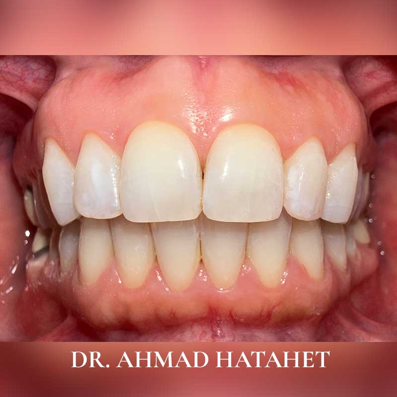 After dental treatment case 5
