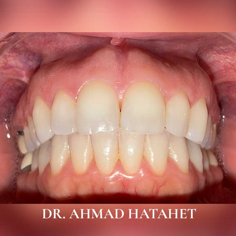 Before dental treatment case 5
