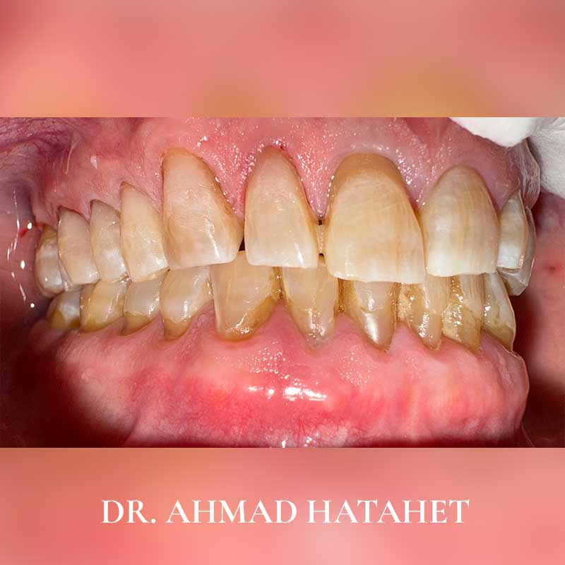 After dental treatment case 6