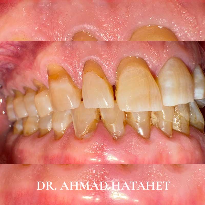 Before dental treatment case 6